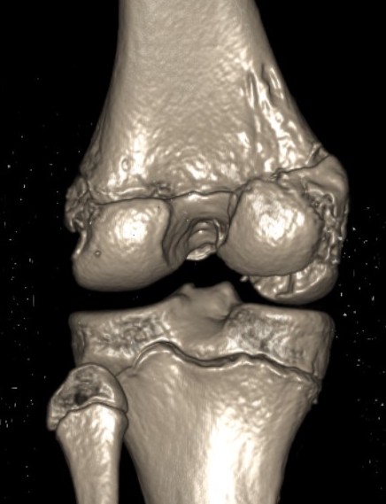 Medial Hoffa CT 4